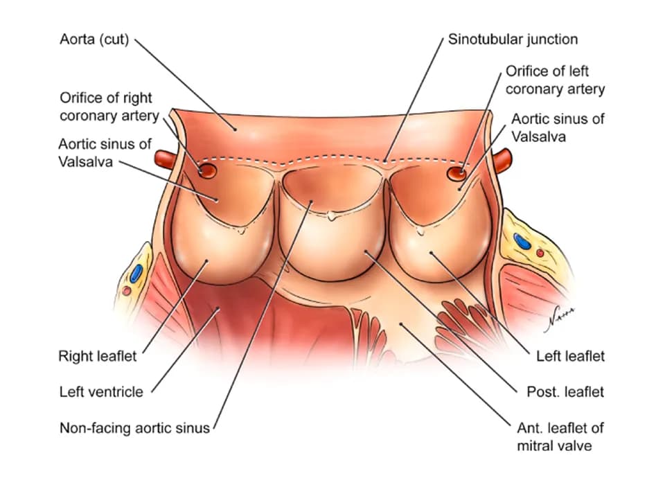Ruptured Sinus of Valsalva (RSOV) Device Closure