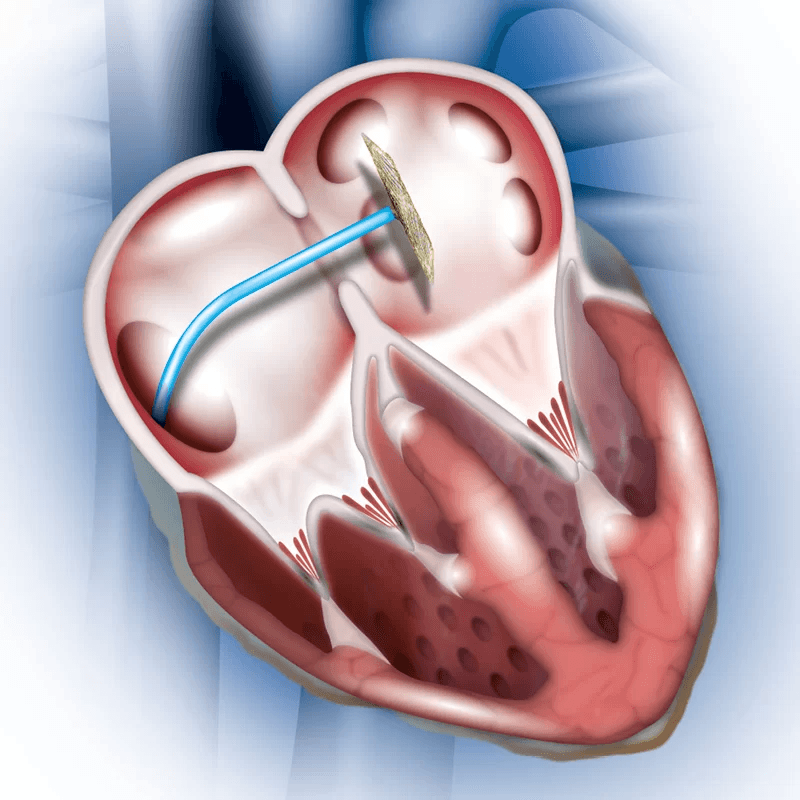 TEER Surgery