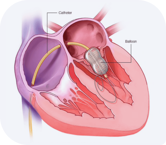 TEER Surgery