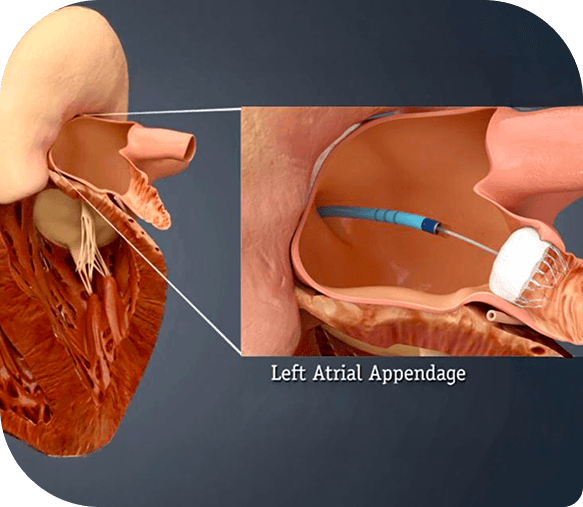 TEER Surgery