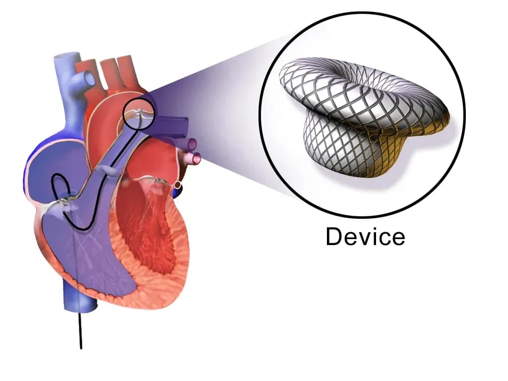 ASD Closure Illustration