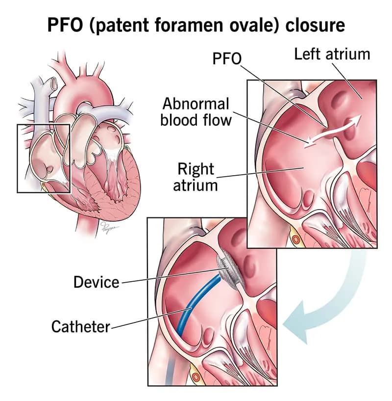 ASD Closure Illustration