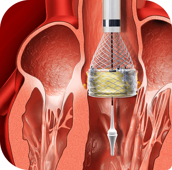 TAVI Surgery
