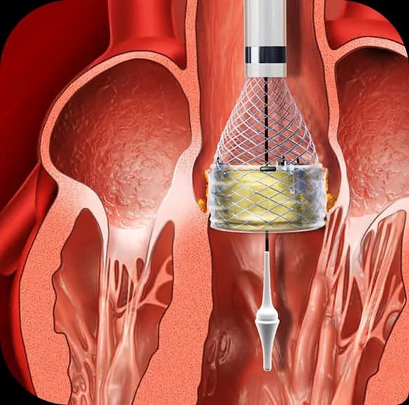 TAVI Surgery