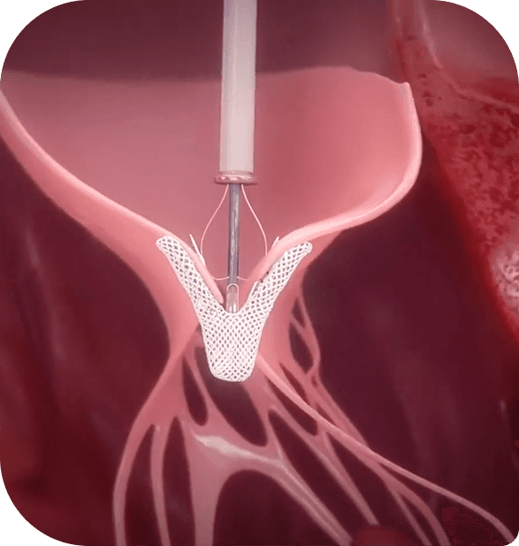 TEER Procedure