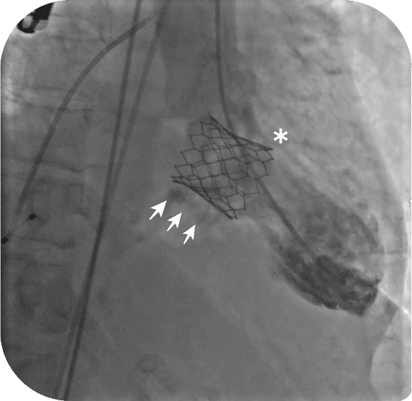 TEER Surgery