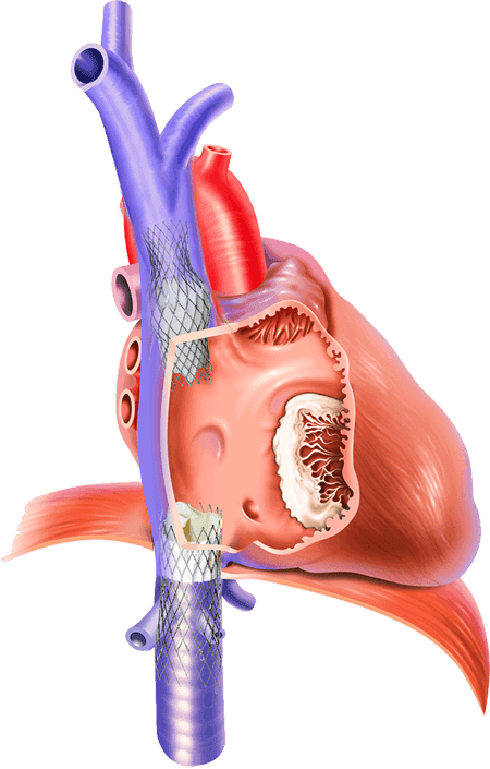 TEER Surgery