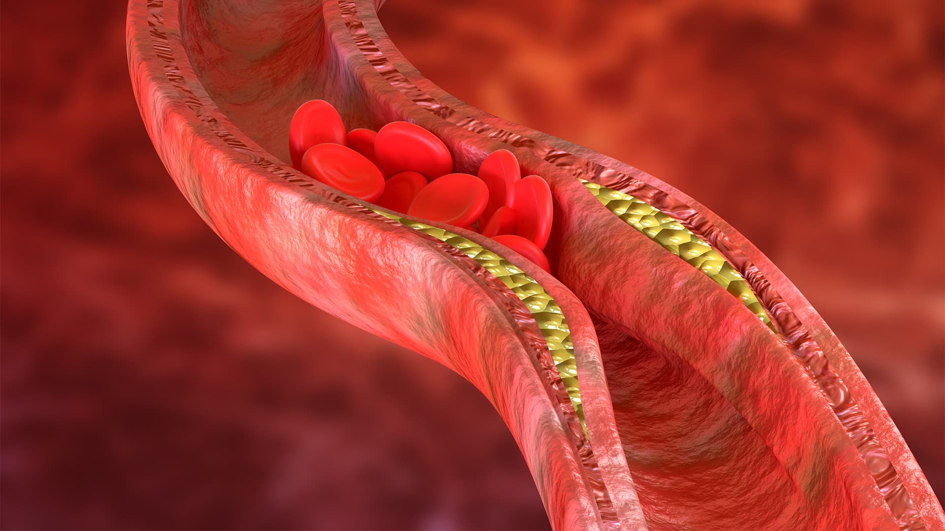 TMVR(Transcatheter Mitral Valve Replacement): What Is It?