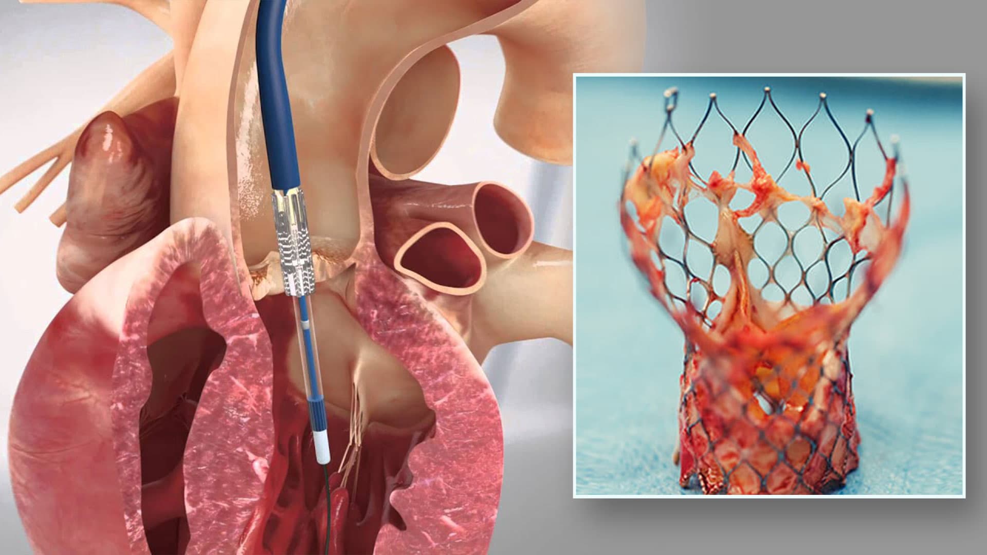 Pre-operative workup for TAVI