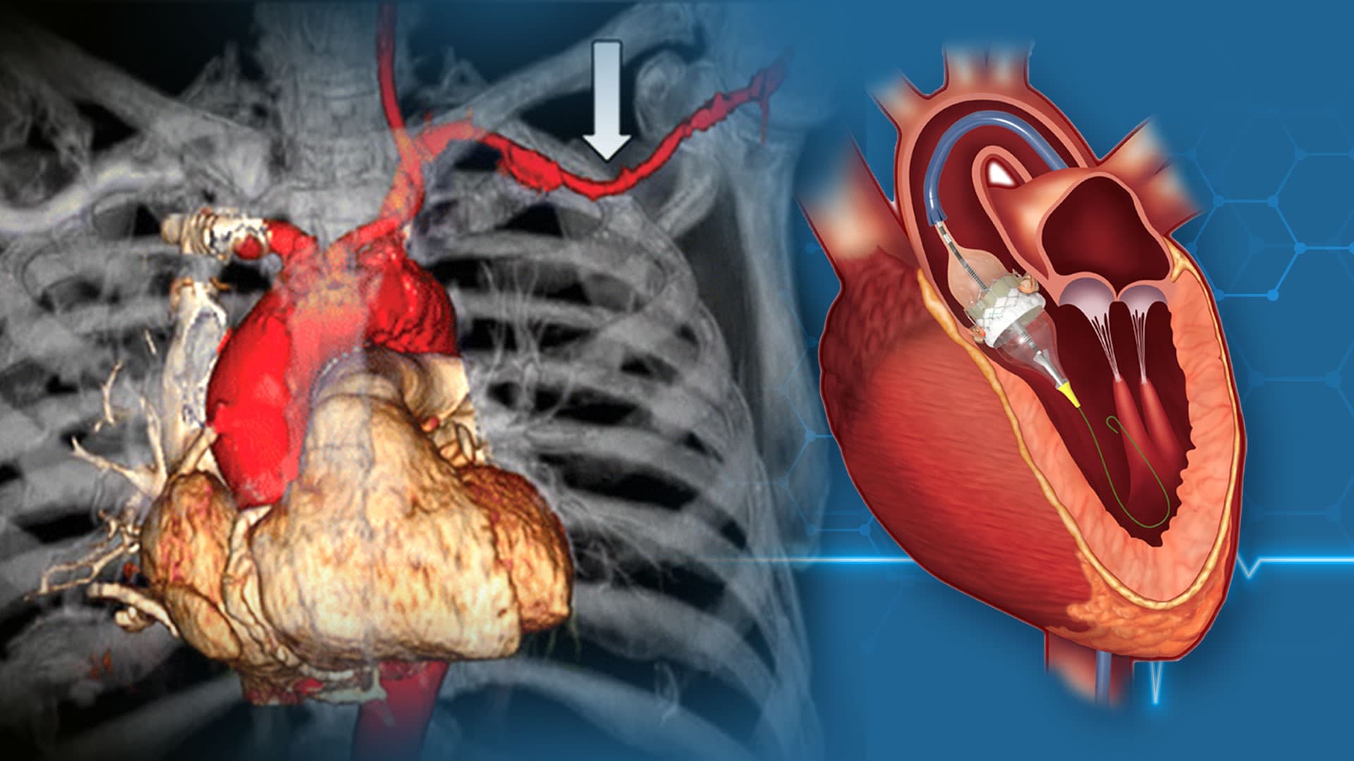 Alternative Routes for TAVI