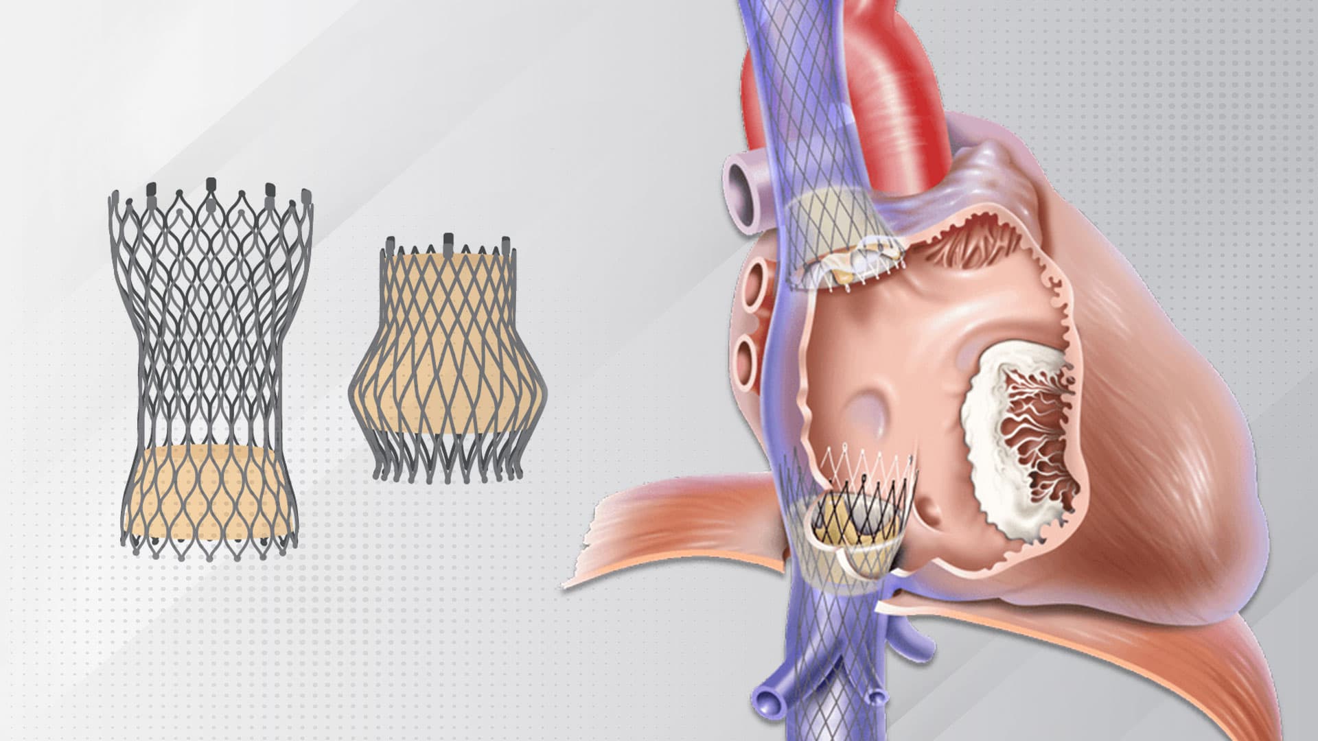 Tricvalve: For Whom and When?