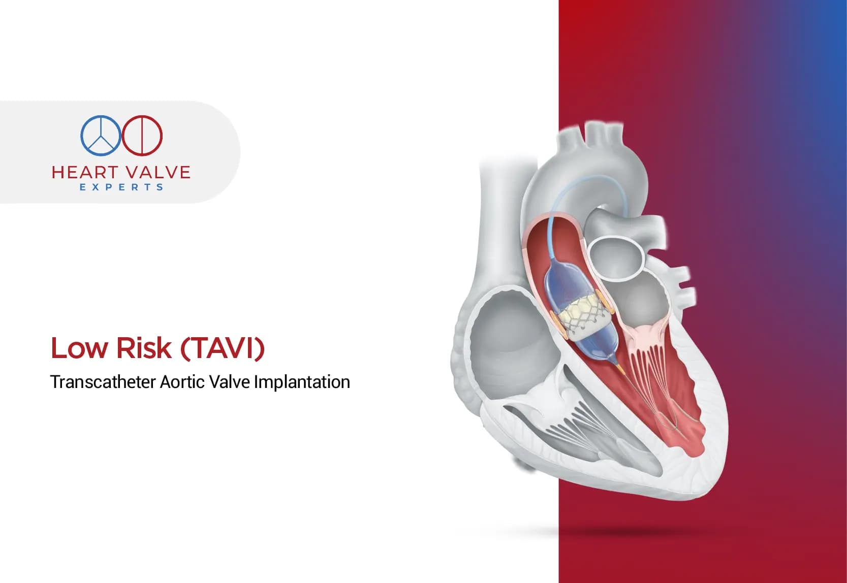 Low Risk TAVI: A New Era in Heart Valve Treatment