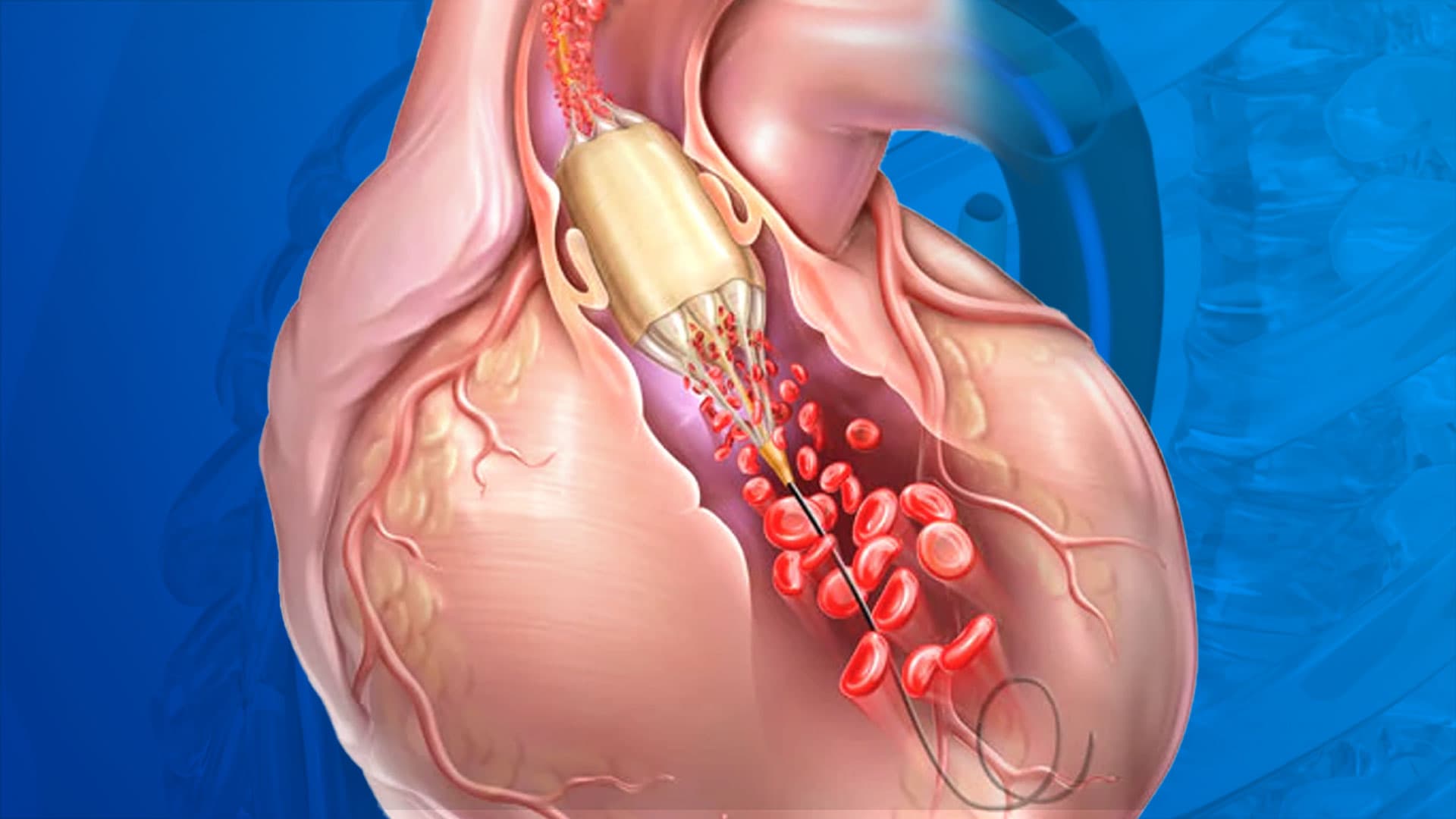 Balloon Pulmonary Valvotomy