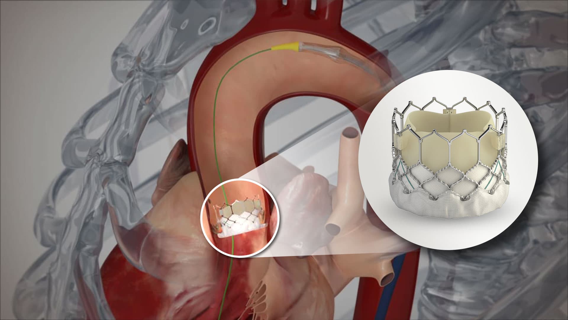 Durability of TAVI valve