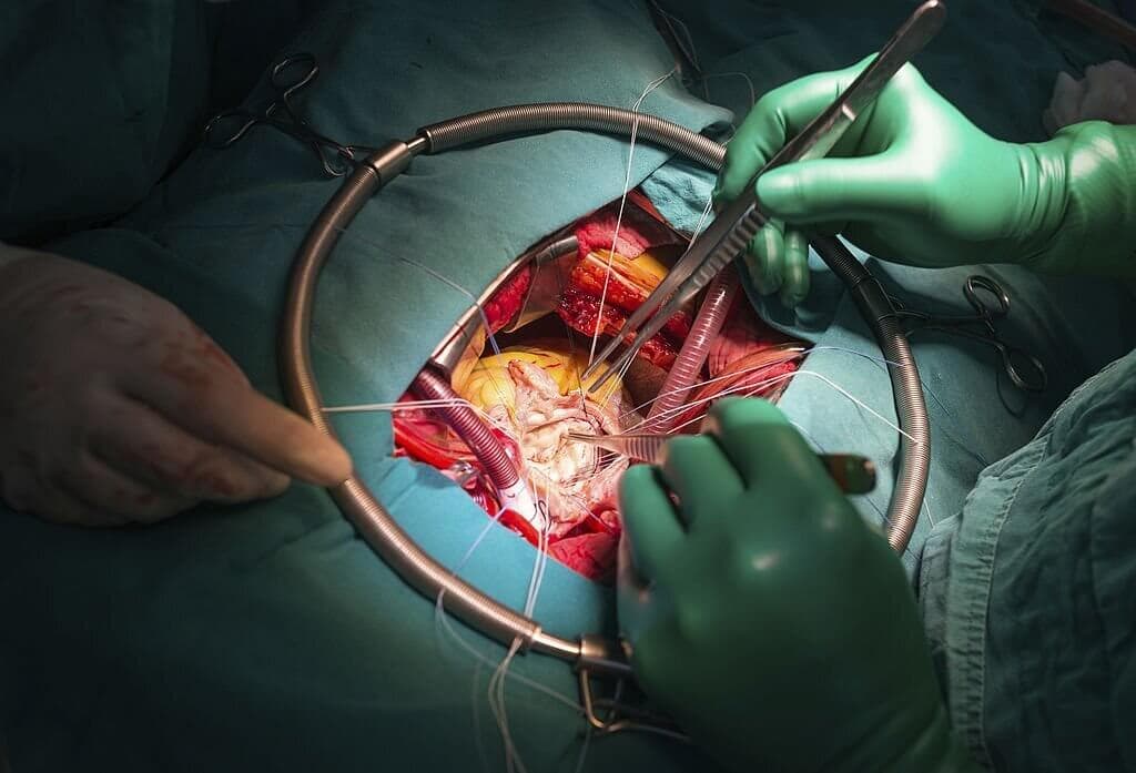 Treatment Modalities Available for Severe Mitral Stenosis