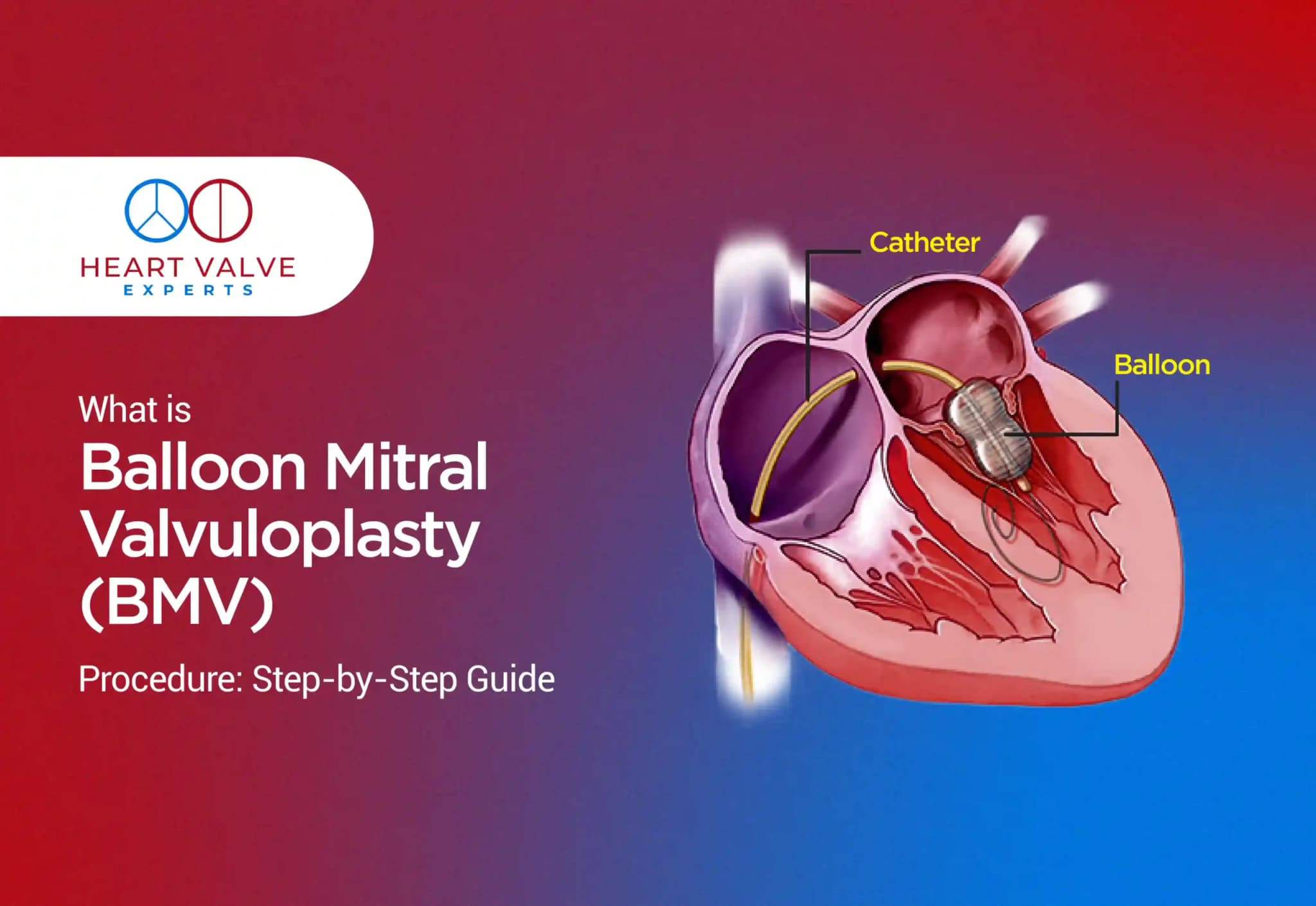 What is Balloon Mitral Valvuloplasty (BMV) Procedure: Step-by-Step Guide