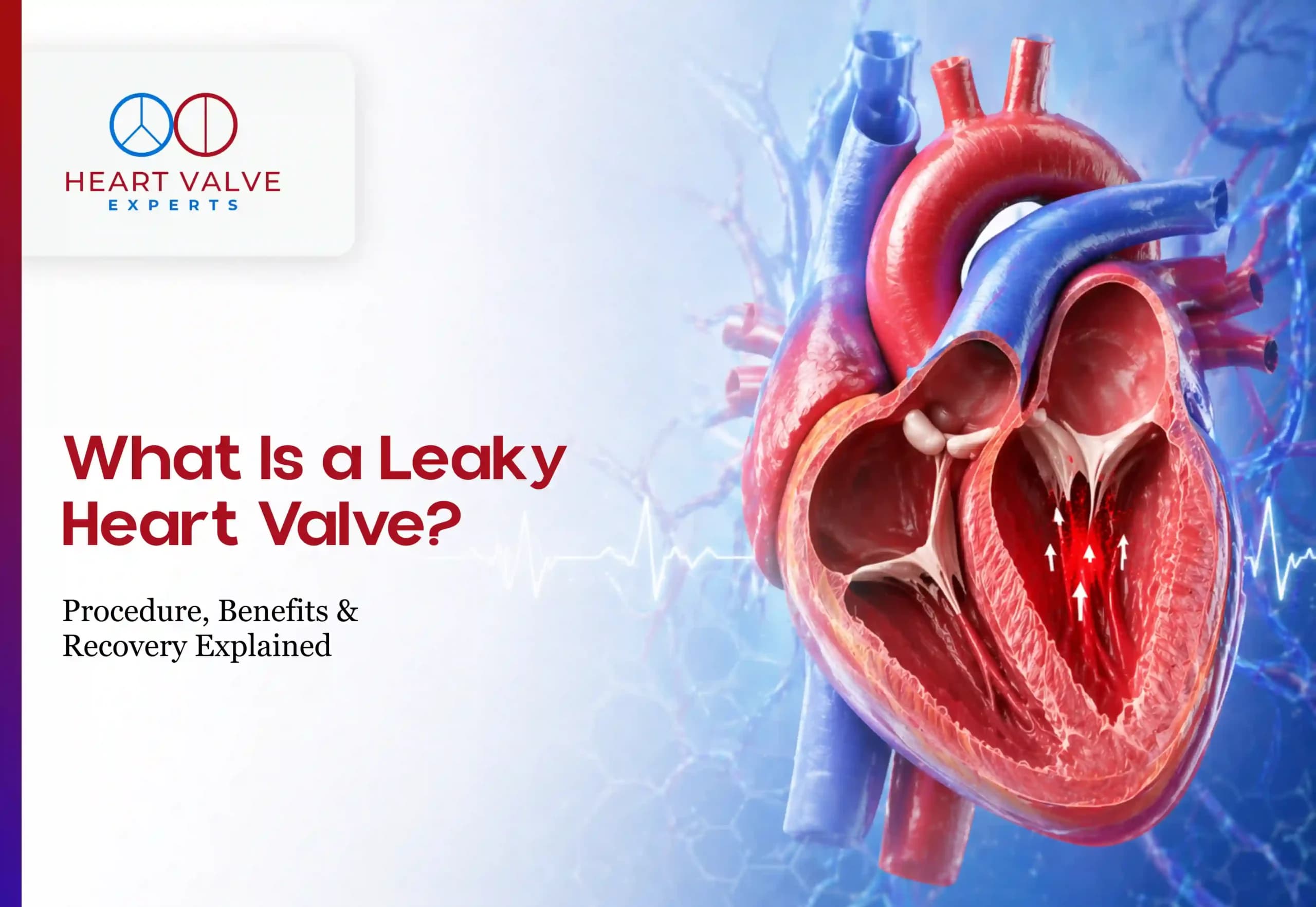 What Is a Leaky Heart Valve? Symptoms, Causes and Treatment Options