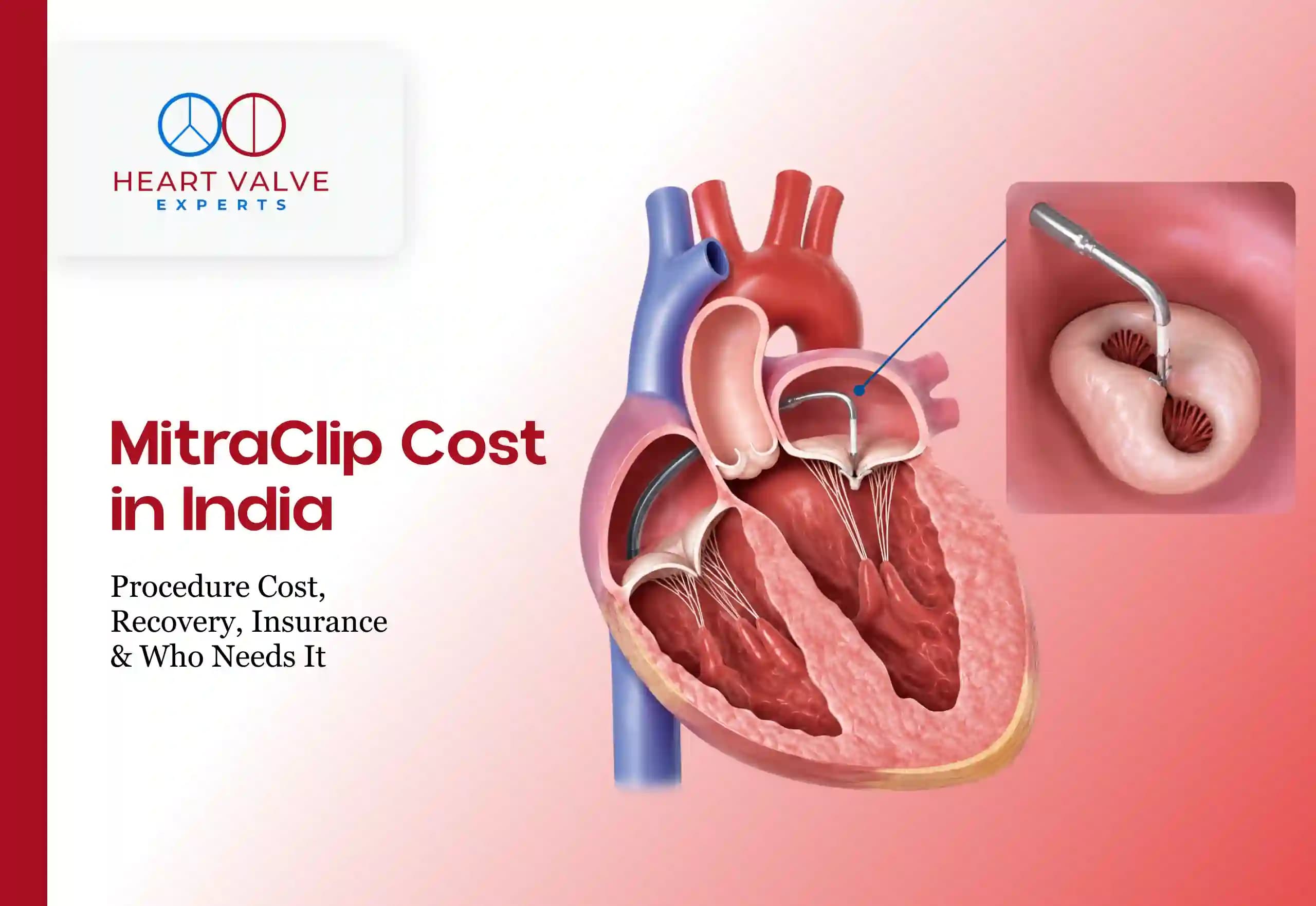 MitraClip Cost in India: Procedure Cost, Recovery, Insurance &amp; Who Needs It