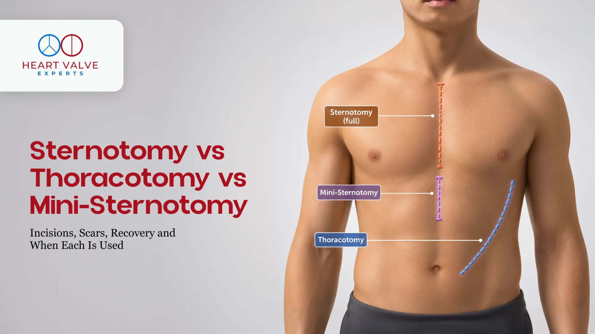 Sternotomy vs Thoracotomy vs Mini-Sternotomy: Incisions, Scars, Recovery and When Each Is Used