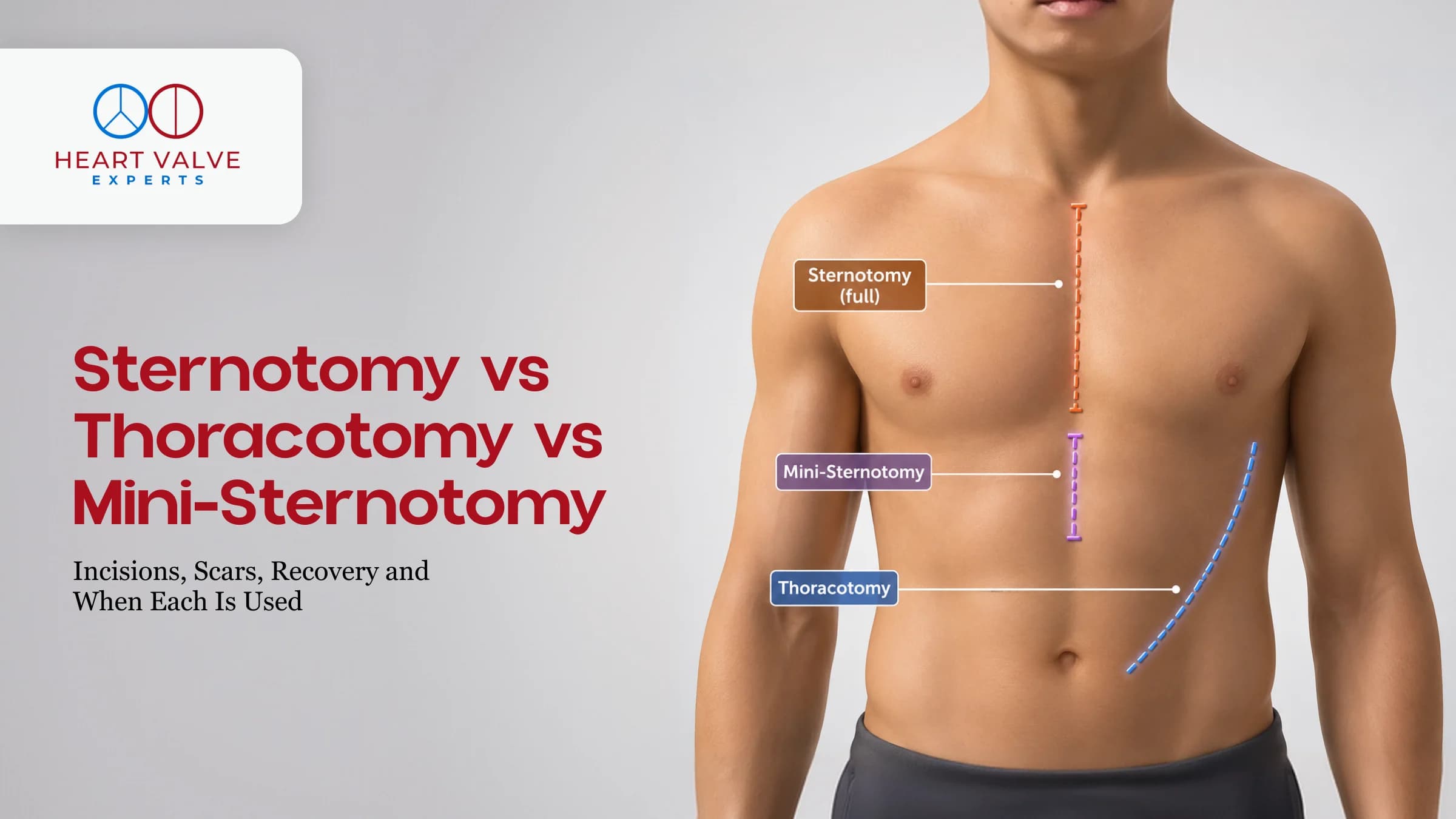 Sternotomy vs Thoracotomy vs Mini-Sternotomy: Incisions, Scars, Recovery and When Each Is Used