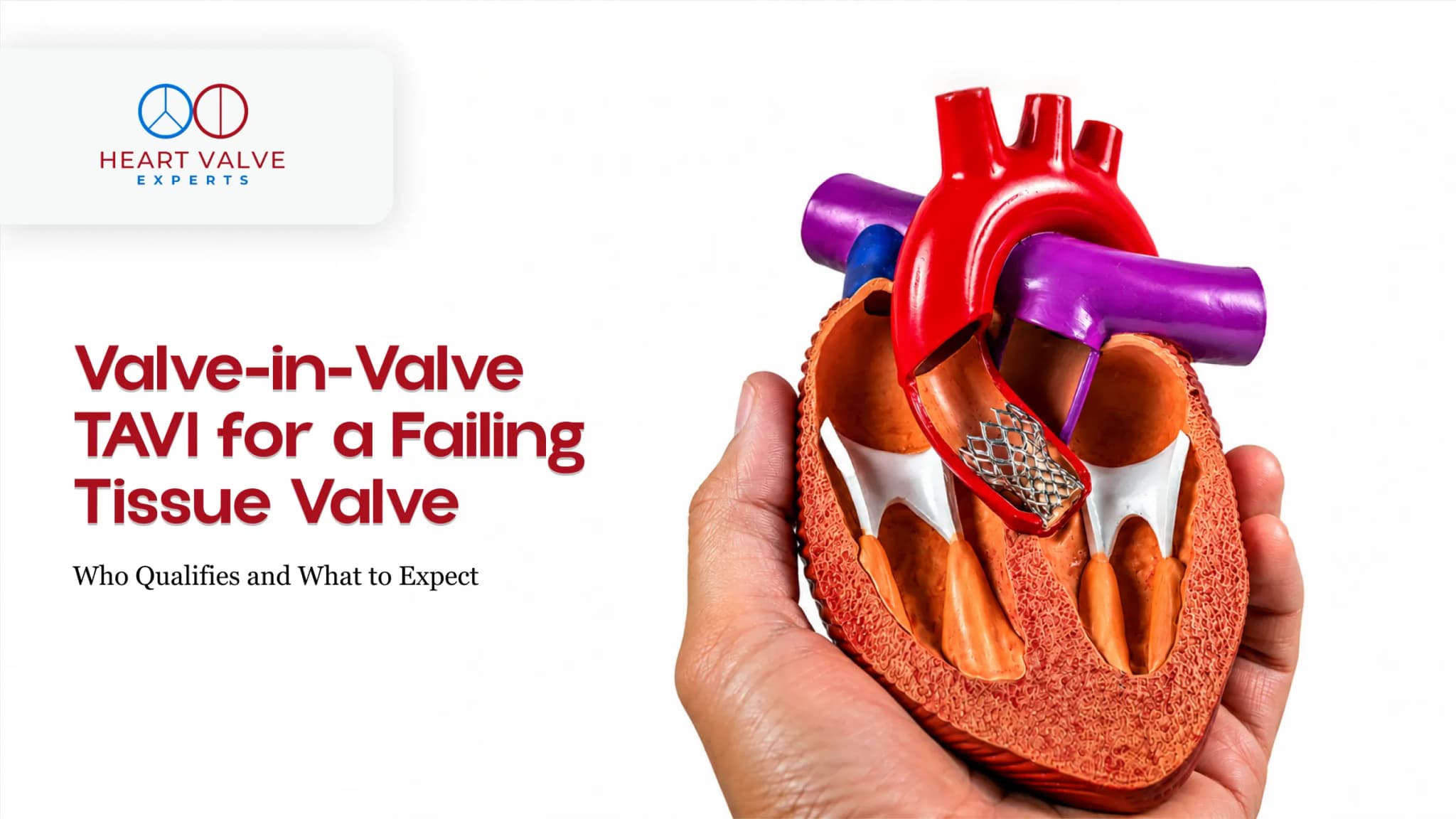 Valve-in-Valve TAVI for a Failing Tissue Valve: Who Qualifies and What to Expect