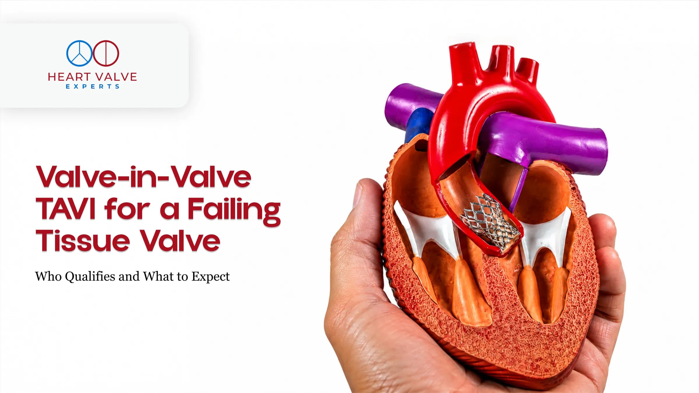 Valve-in-Valve TAVI for a Failing Tissue Valve: Who Qualifies and What to Expect