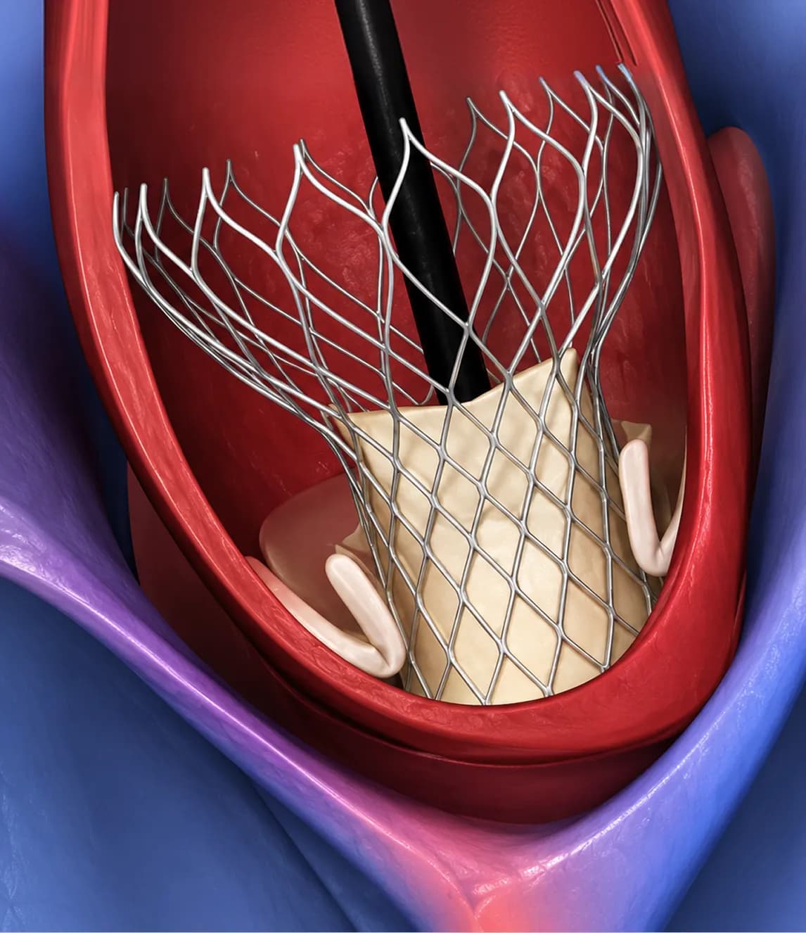 Heart Valve Treatment in India for Patients From Bangladesh