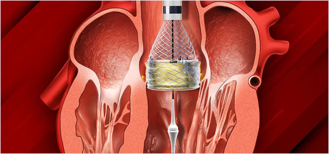 Aortic Stenosis and TAVI/TAVR Assessment
