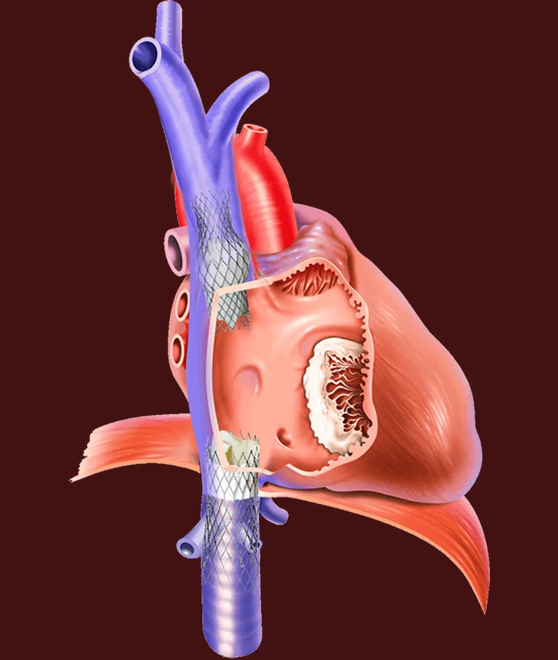 Heart Valve Treatment in India for Patients From Oman