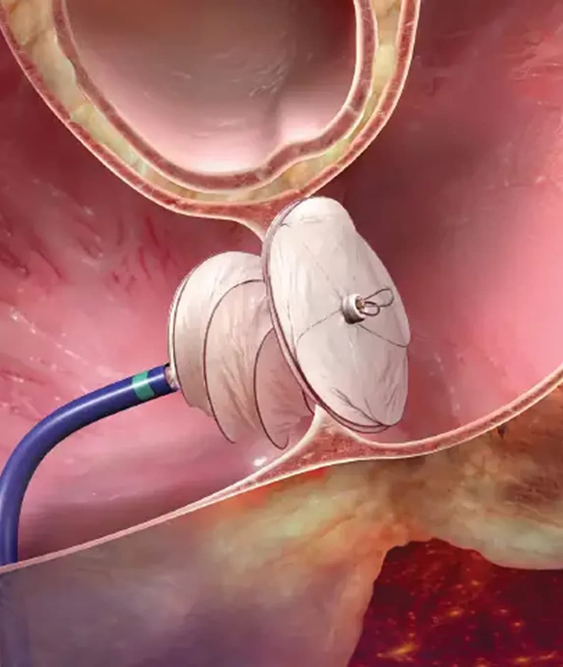 Heart Valve Treatment in India for Patients From Nigeria
