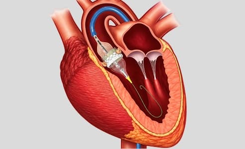 Transcatheter Advances
