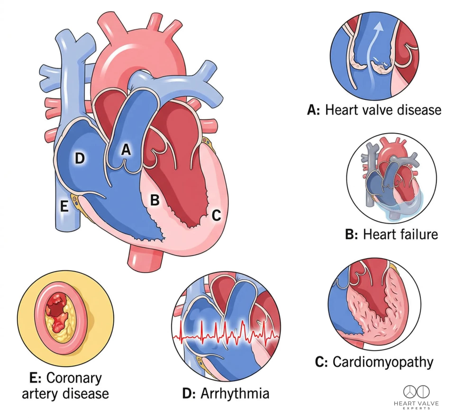 Who is Eligible for TAVI Surgery in Mumbai?