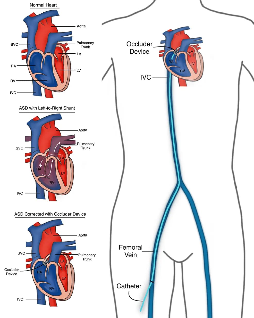 ASD Closure Illustration