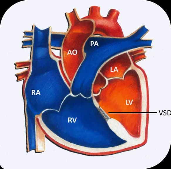 ASD Closure Illustration