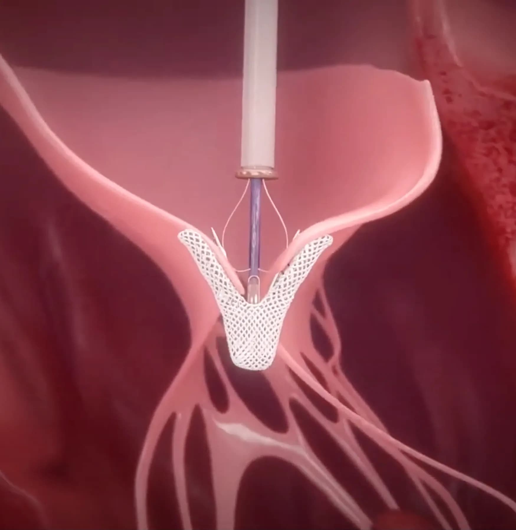 MitraClip in Mumbai – Advanced Minimally Invasive Mitral Valve Repair