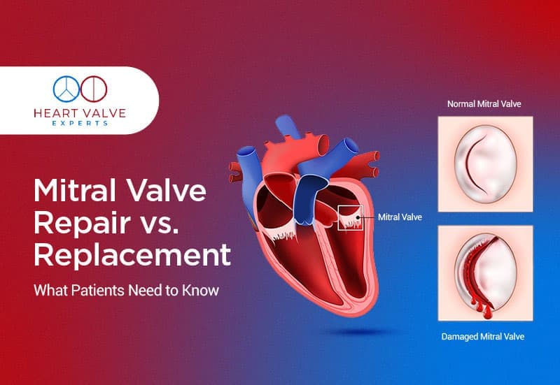 Mitral Valve Repair vs. Replacement: What Patients Need to Know?