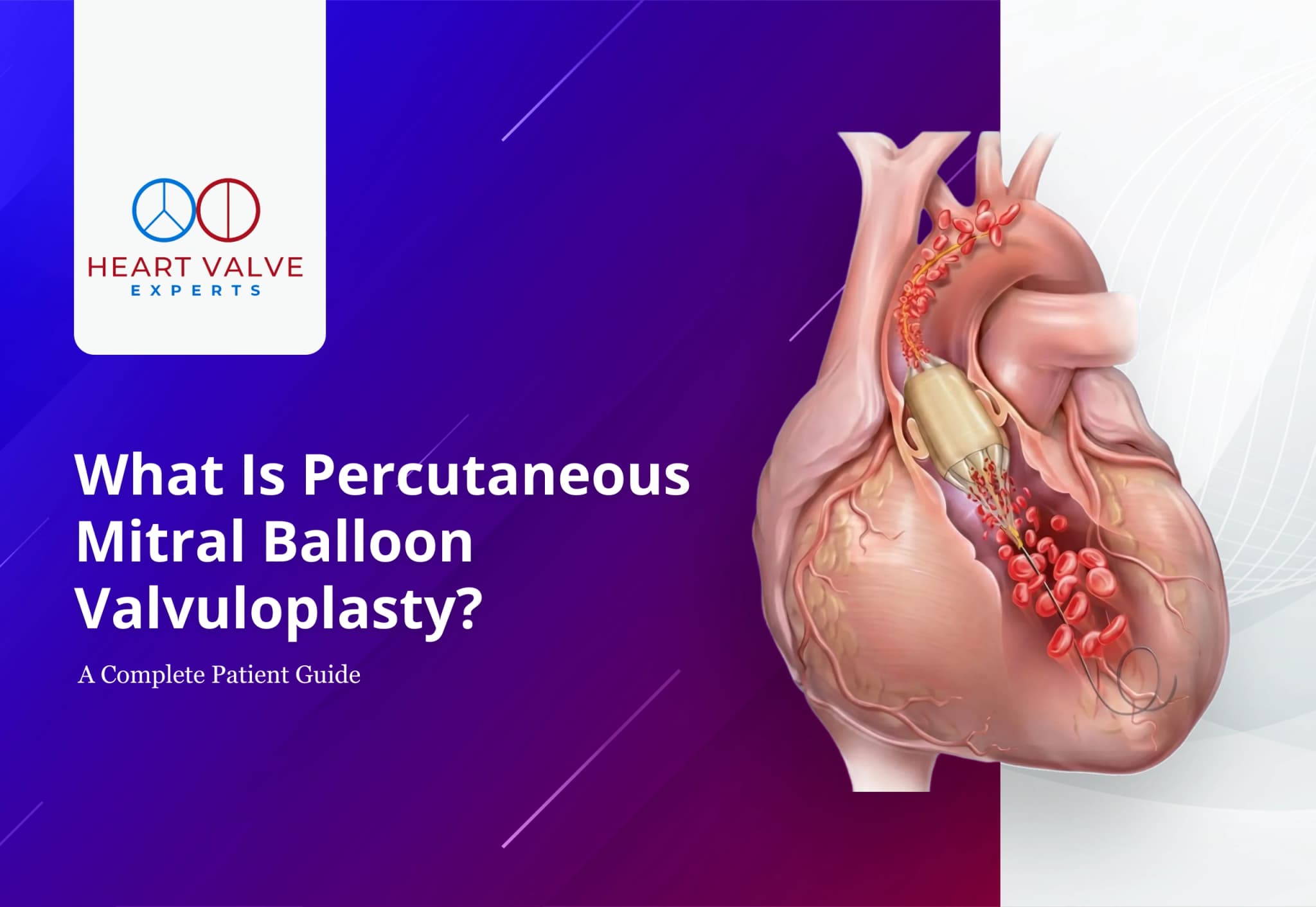 What Is Percutaneous Mitral Balloon Valvuloplasty? A Complete Patient Guide