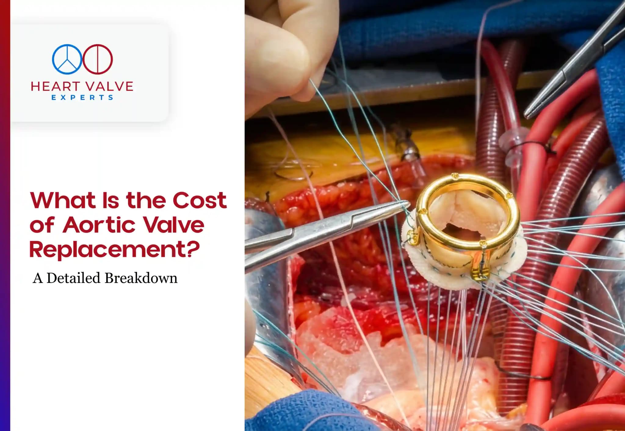 What Is the Cost of Aortic Valve Replacement? A Detailed Breakdown
