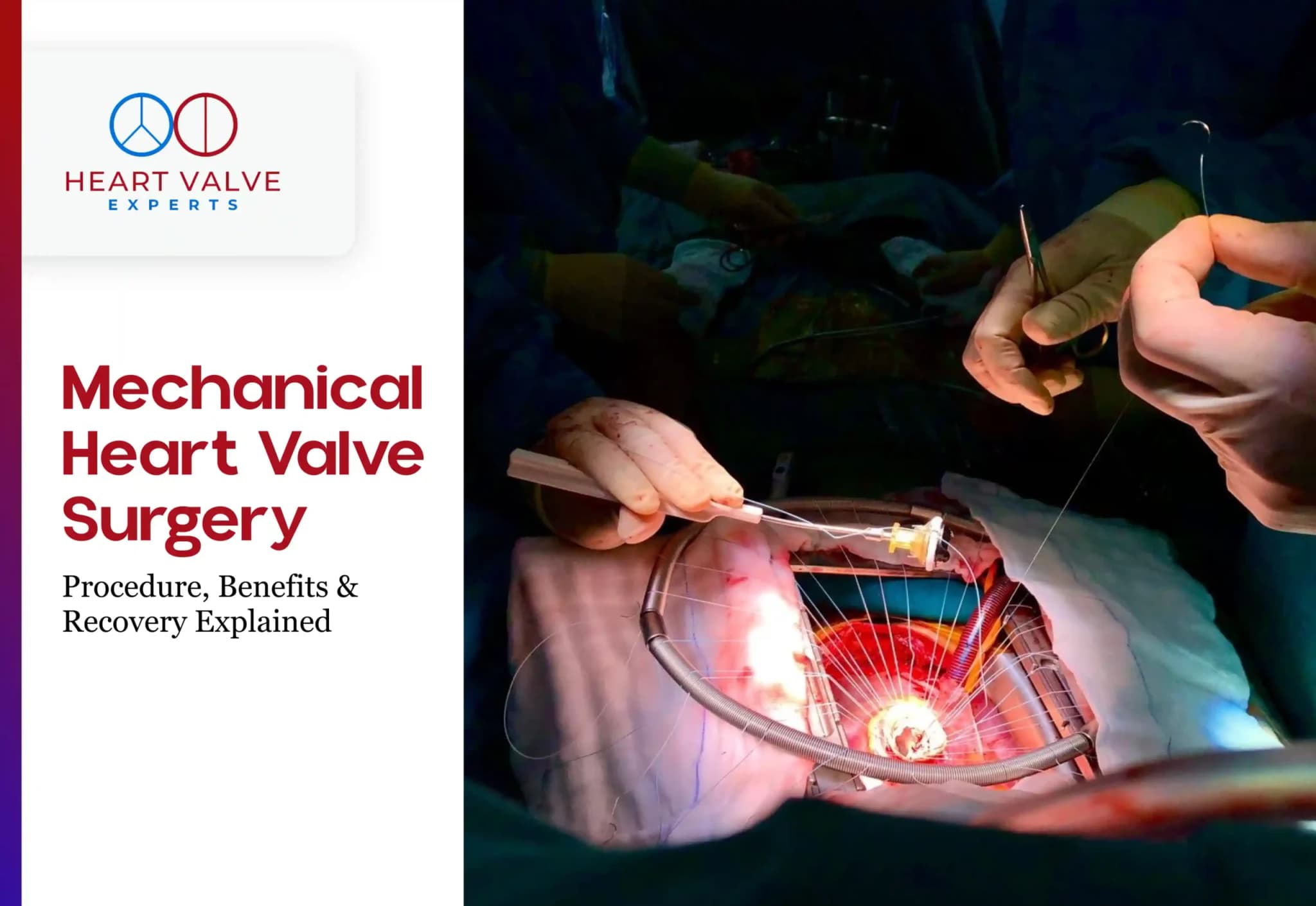 Mechanical Heart Valve Surgery: Procedure, Benefits & Recovery Explained