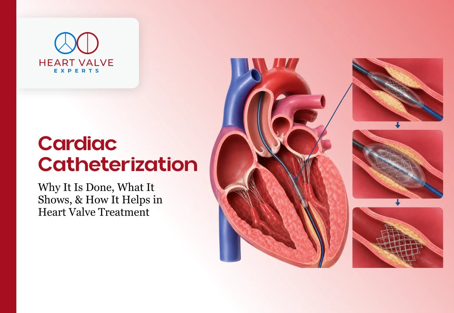 Cardiac Catheterization: Why It Is Done, What It Shows, and How It Helps in Heart Valve Treatment