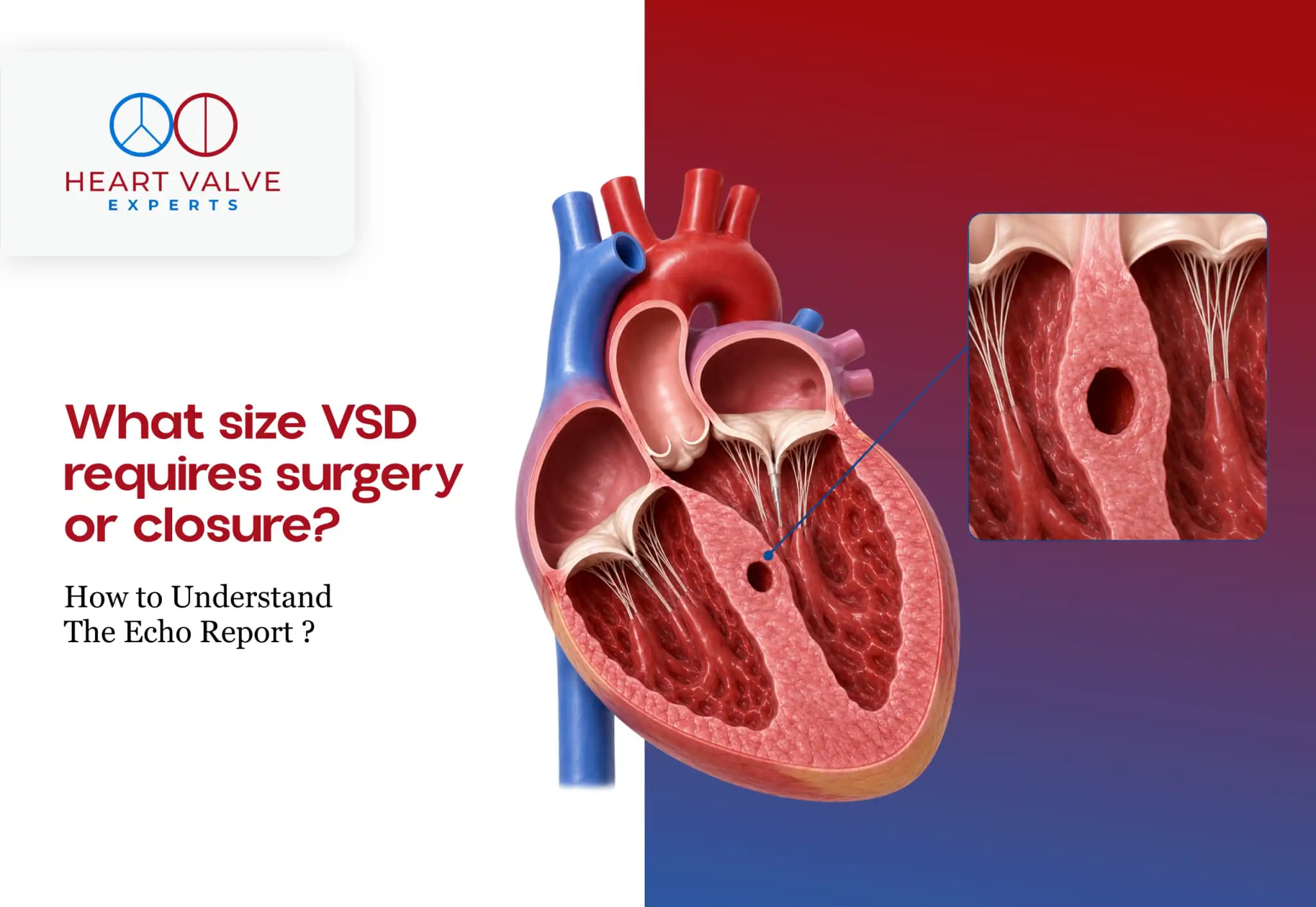 Small, Moderate or Large VSD: How to Understand Your Echo Report and Know When Closure May Be Needed