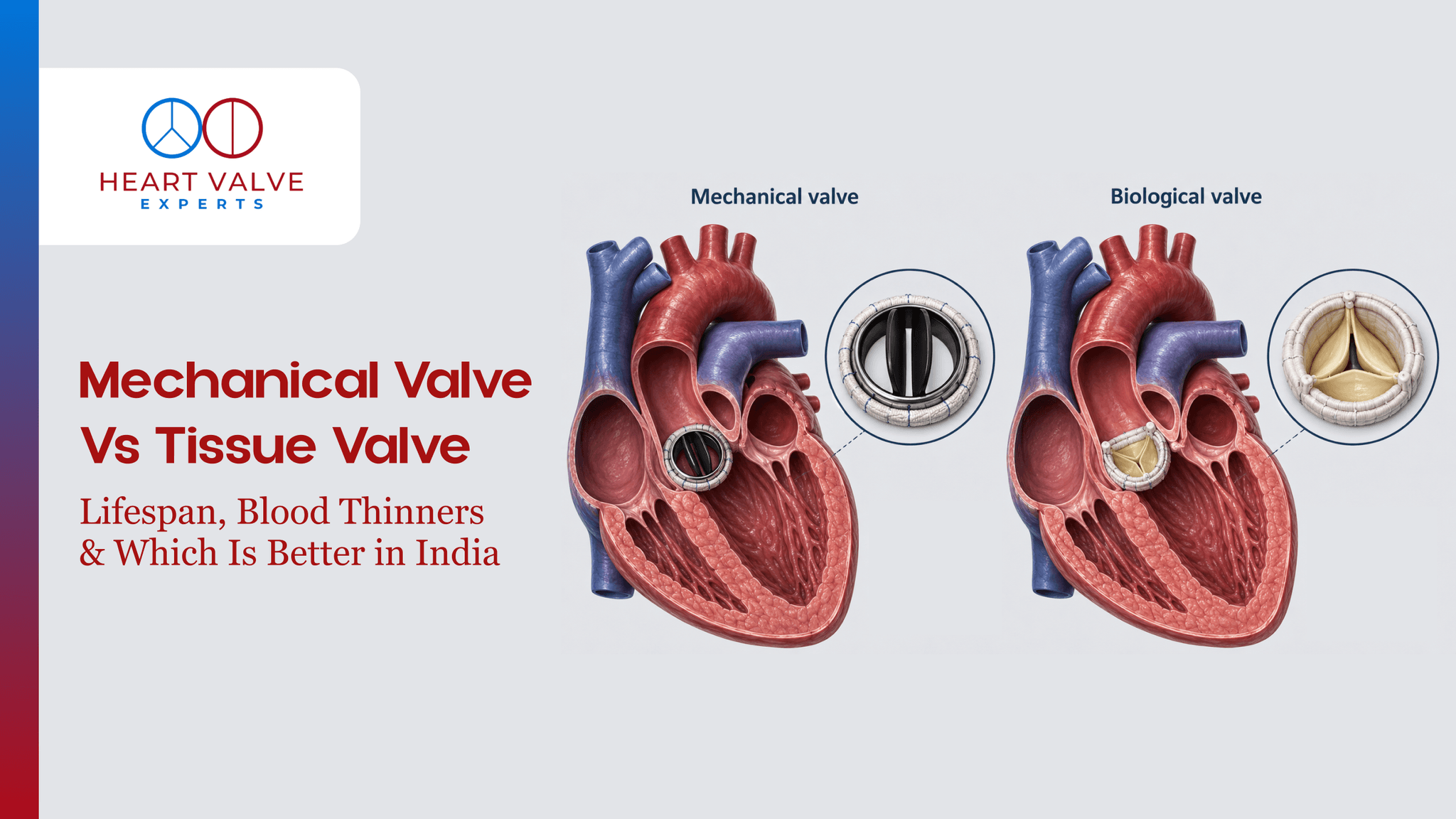 Mechanical vs Tissue Valve for Active Patients: Lifestyle, Blood Thinners, Durability & Long-Term Choice