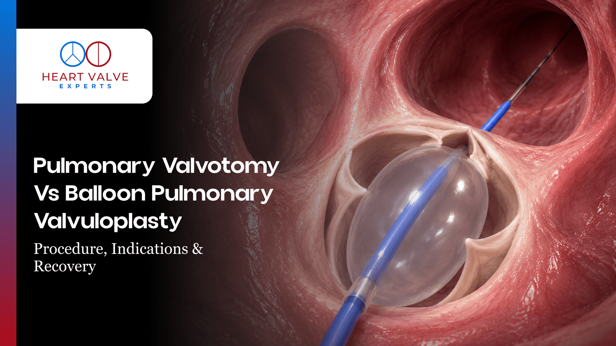 Pulmonary Valvotomy vs Balloon Pulmonary Valvuloplasty for Pulmonary Stenosis