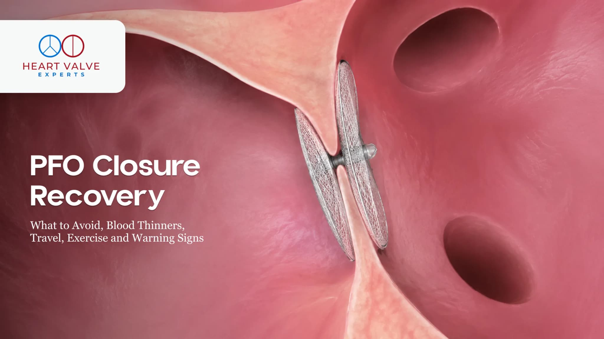 PFO Closure Recovery Time: Safe Timelines, Side Effects, and What to Avoid