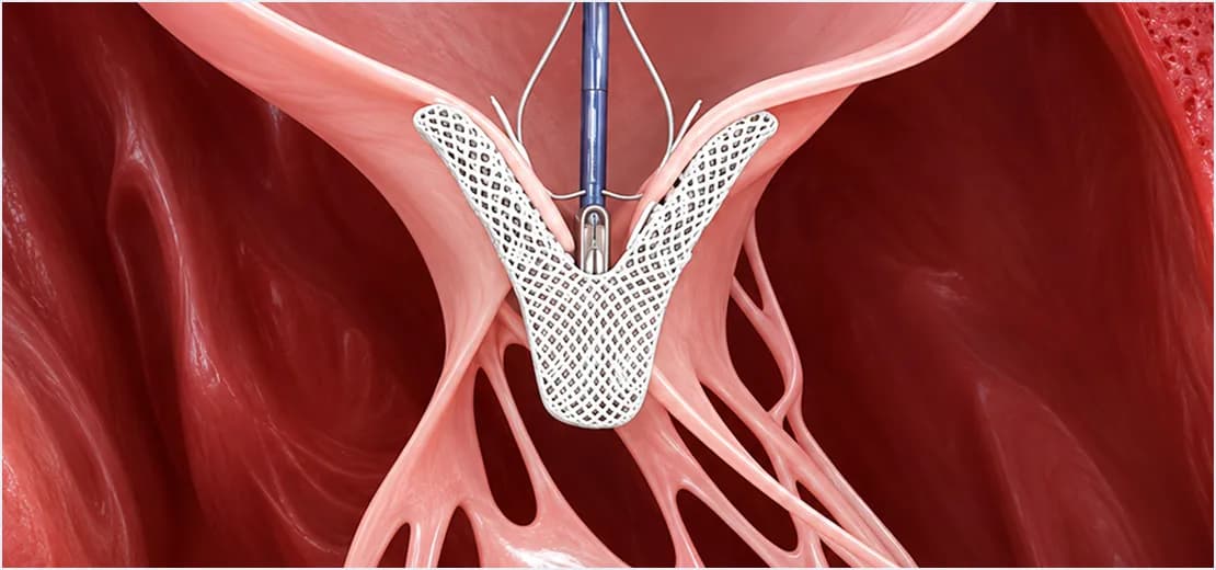 Mitral Regurgitation and TEER Assessment