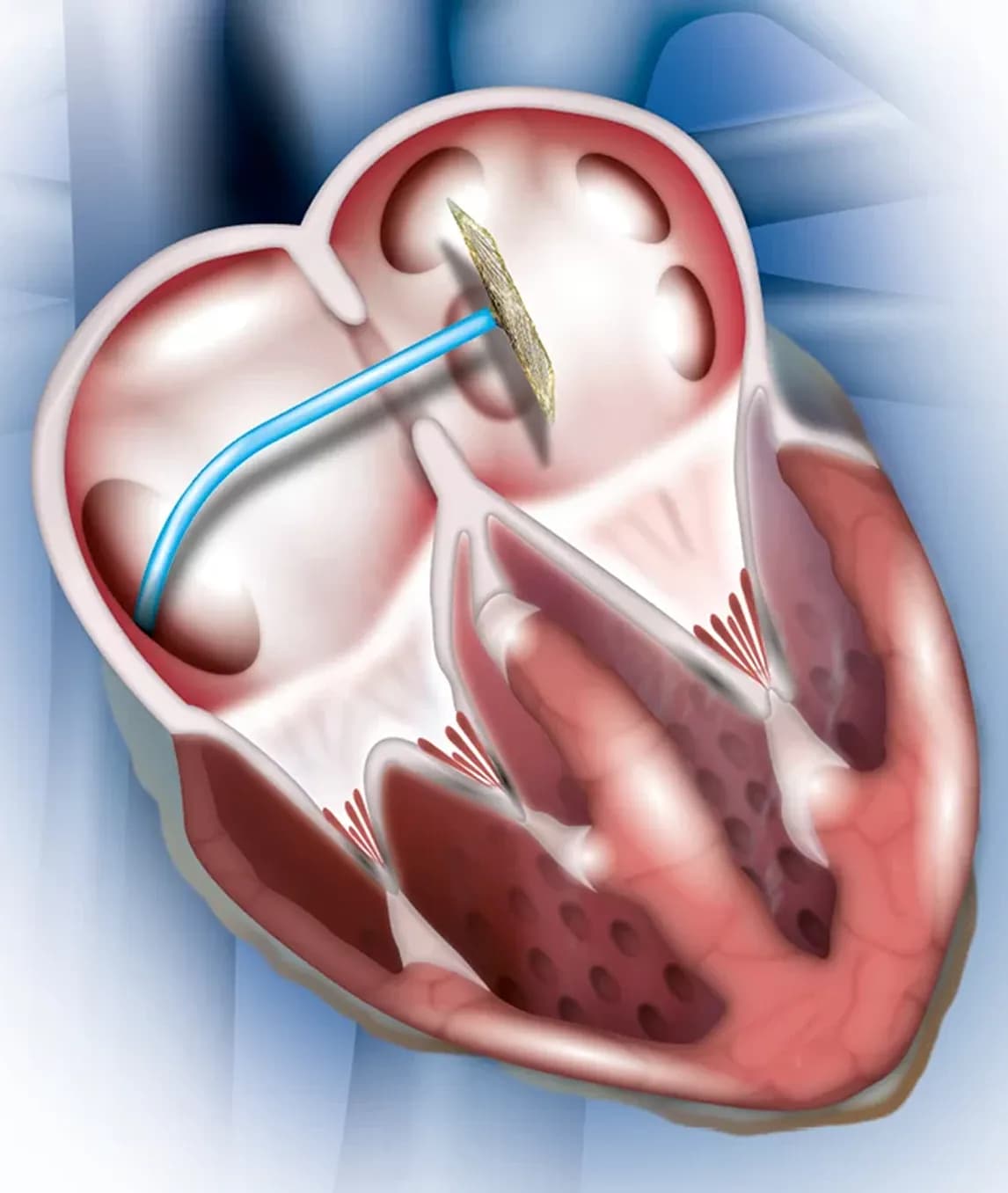 Heart Valve Treatment and ASD Closure in India for Patients From Somalia