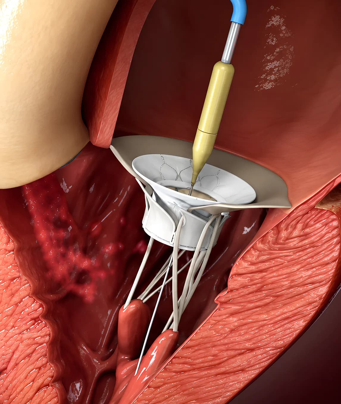 Heart Valve Treatment in India for Patients From Kenya