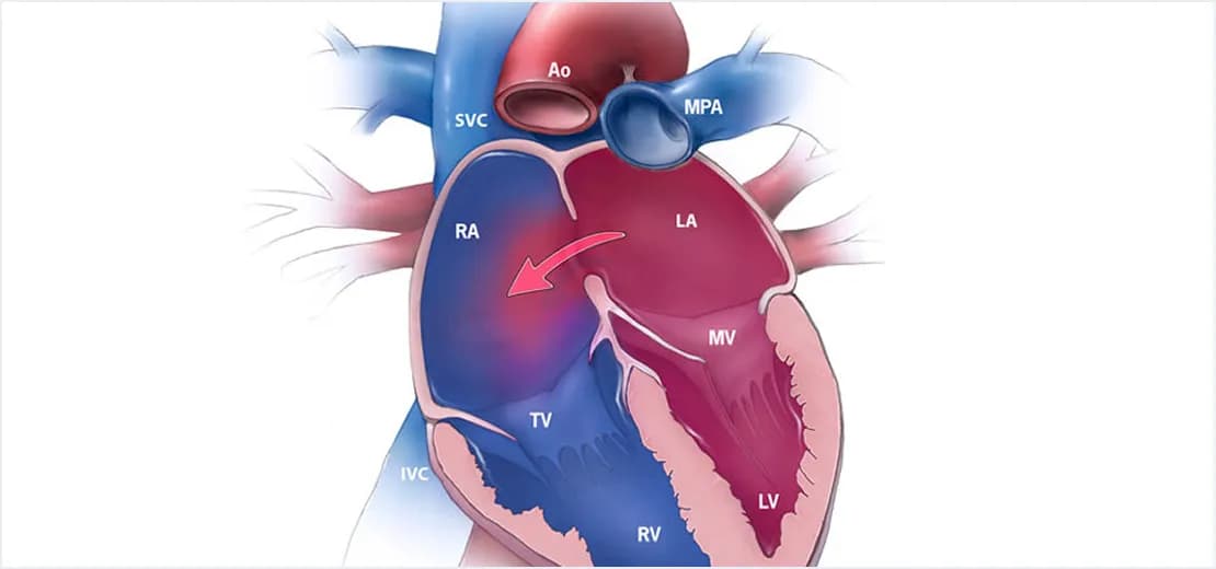 Atrial Septal Defect Assessment
