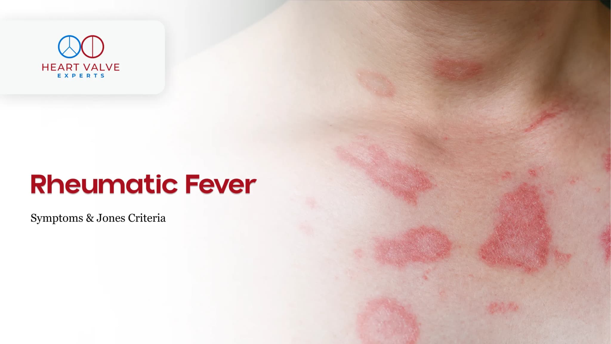 Rheumatic Fever – Symptoms, Jones Criteria and How It Damages Heart Valves