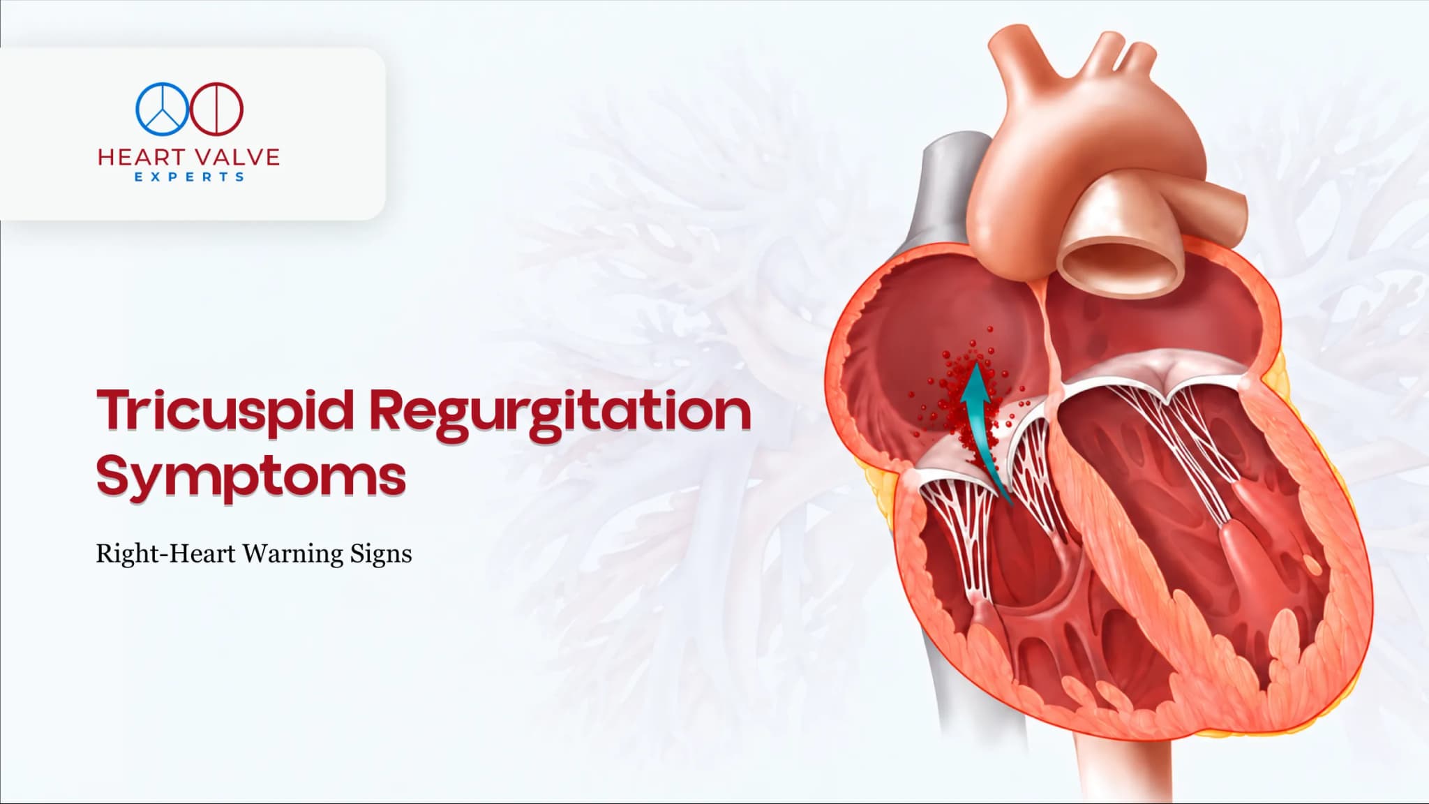 Tricuspid Regurgitation Treatment